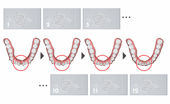 マウスピース矯正のポイント